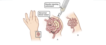 AVM Embolisation